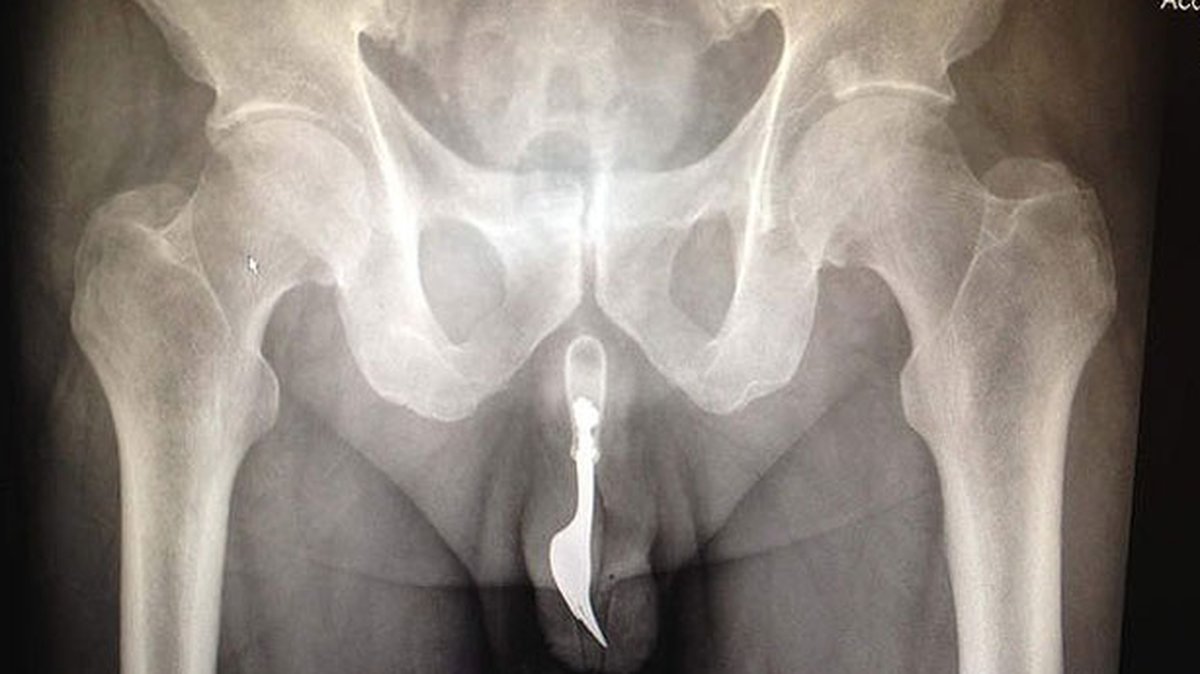 Röntgenbilden av hans penis.